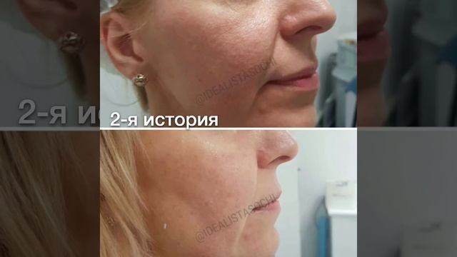 Фотоомоложение - три истории смотреть онлайн