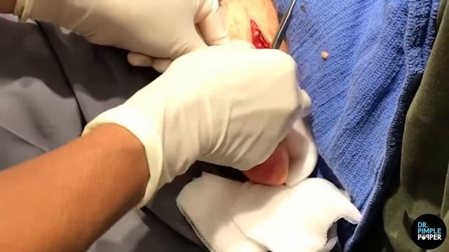 ACNE REMOVAL | ACNE TREATMENT#6