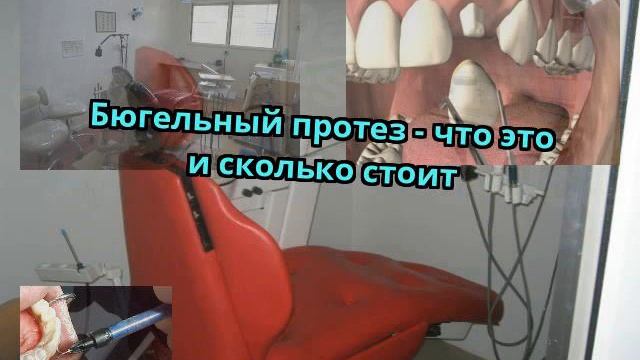 Бюгельный протез - что это и сколько стоит смотреть онлайн
