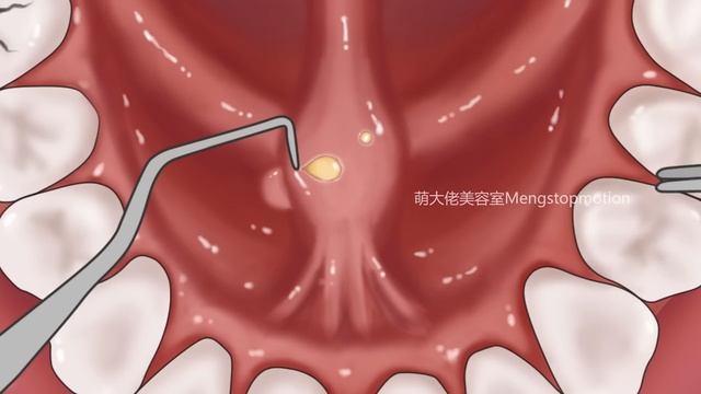 ASMR Get Rid of Bad Breath! Tonsil Stone Removal, Salivary Glands Cleaning | Meng's Stop Motion смотреть онлайн