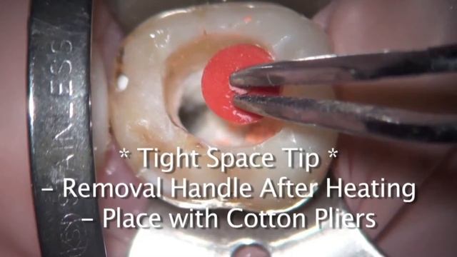 Full GuttaCore® Placement Technique with Dr. Landwehr смотреть онлайн