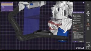 Гипсовка по КТ в виртуальный артикулятор