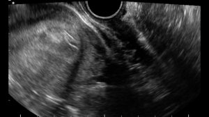 Беременность 5-6 недель, двойня 5-6 недель. УЗИ (29-10-17)