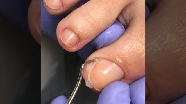 Педикюр. Мозоль. Тампонирование. Вросший ноготь