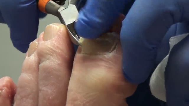 The Whole Big Toenail Comes Off!! Are You Watching This Video?