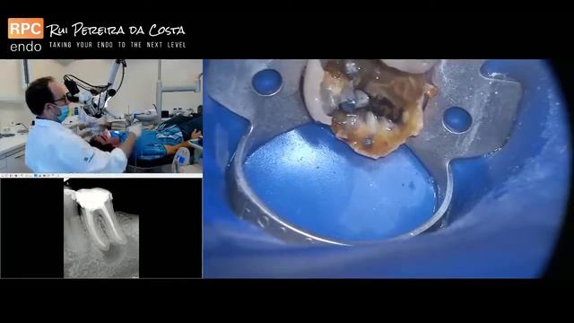 Já deixaste escapar esta avaliação pré-Endo? смотреть онлайн