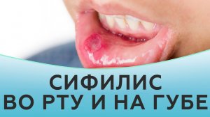 Сифилис во рту и на губе.