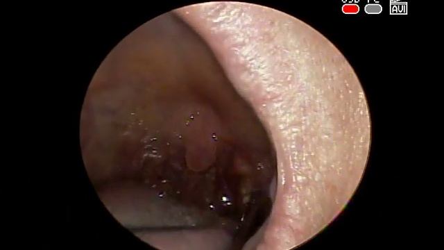 ПРОМЫВАНИЕ #МИНДАЛИН #ПРОБКИ STONE REMOVAL TONSIL LAVAGE ХРОНИЧЕСКИЙ #ТОНЗИЛЛИТ ЛОР ВРАЧ смотреть онлайн