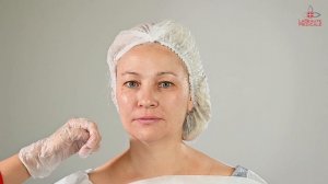 Процедура по восполнению утраченного объёма скуловой области. «Щёчки-яблочки».