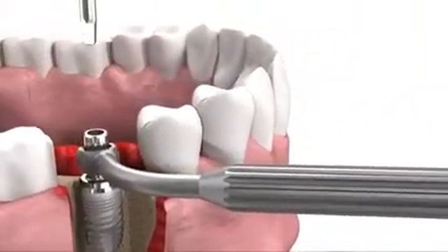 Установка имплантов в разновидности имплантов смотреть онлайн