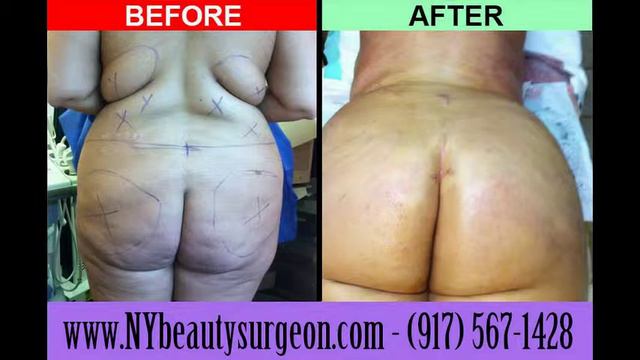 BRAZILIAN BUTT LIFT, BUTT LIFT, BUTTOCKS AUGMENTATION #47 смотреть онлайн
