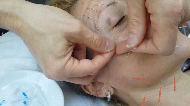 Естетична акупунктура смотреть онлайн